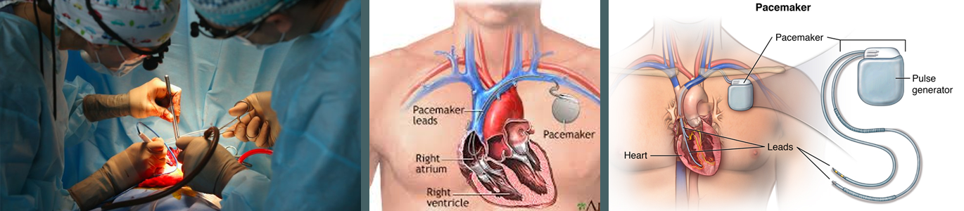 Heart Pacemaker Surgery 