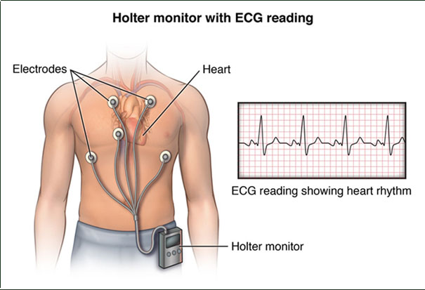 Holter Monitor Test