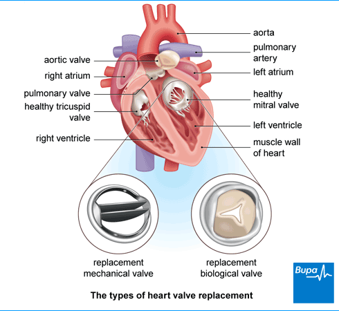 Heart Valve Surgery