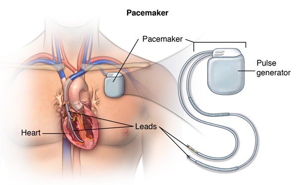 Heart Pacemaker Surgery 